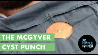 The MacGyver Cyst Punch