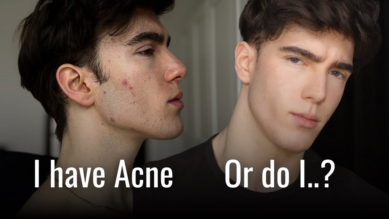Why does no one have Acne anymore?