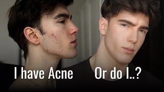 Why does no one have Acne anymore?