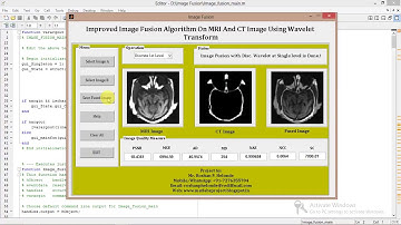 Image Fusion on MRI Images Using DWT, PCA Matlab Project with Source Code