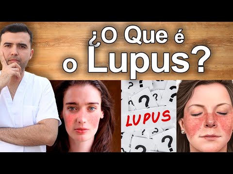O Que é Lúpus? – Sintomas, Causas, e Tratamento Natural
