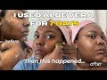 I USED ALOE VERA FOR 7 DAYS HOW I LIGHTENED HYPERPIGMENTATION AT HOME SKIN TRANSFORMATION