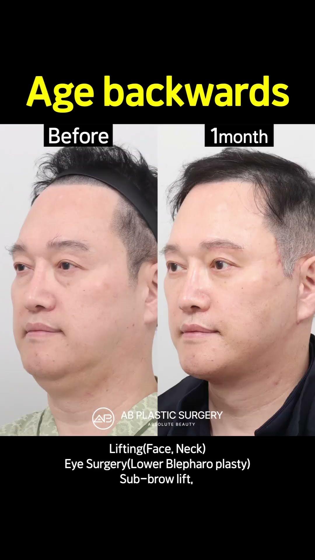 [Plastic Surgery in Korea] Full SMAS lifting & neck lifting & Lower Blepharo plasty, Sub-brow lift