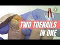 TWO toenails in ONE 😱