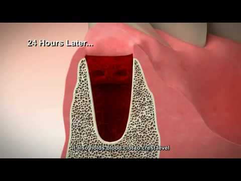 Tooth Extraction and Socket Preservation