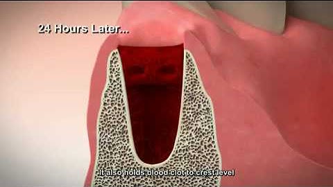 Tooth Extraction and Socket Preservation