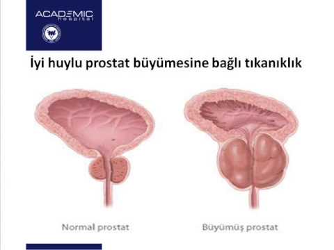 Как снять воспаление простаты у мужчин быстро Erkeklerde Prostat Sorunu - İyi Huylu Prostat Hastalıkları - YouTube