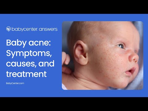 Video: Neonatal acne