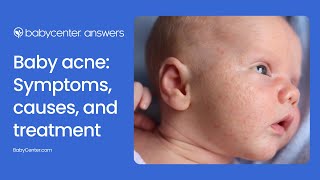 Baby acne: What it looks like, what causes it, and how to treat it
