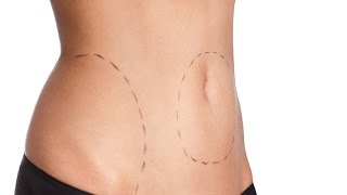 Liposhaping Ve Liposuction Arasında Ne Gibi Fark Vardır?