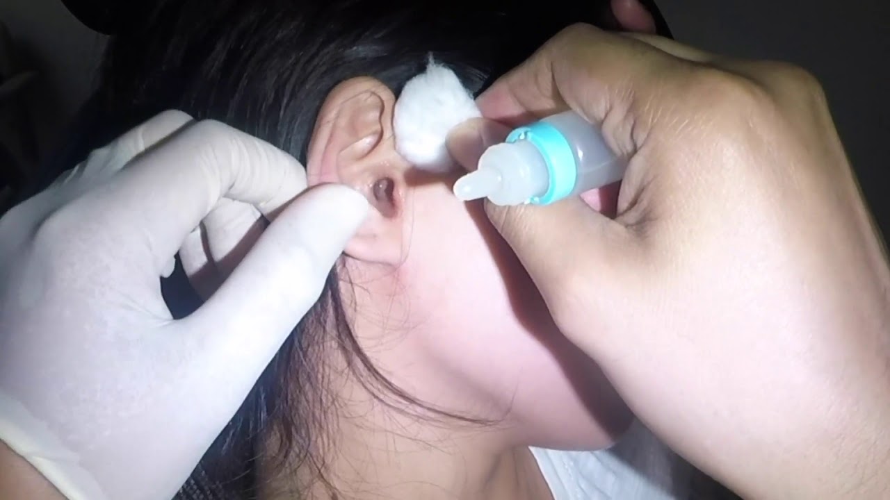 Removing Hard Impacted Earwax From Man & Woman's Ears Removing Hard Impacted Earwax From Man & Woman's Ears