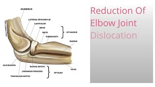 Reduction of dislocated elbow joint