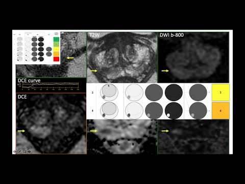 Urowebinar: Prostate cancer