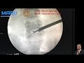 SSULA - Stitchless Spine Surgery under Local Anaesthesia in an awake and aware patient