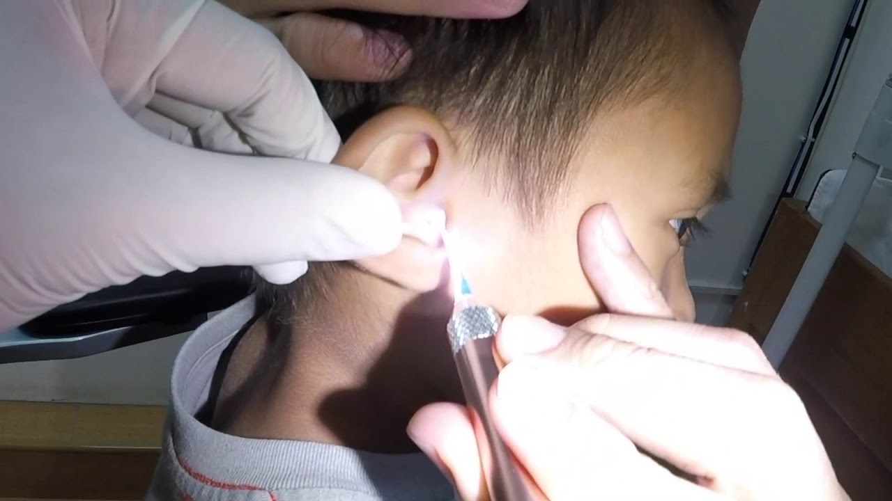 Brave Little Boy's Rock Hard Earwax Removed without Applying Earwax Softener
