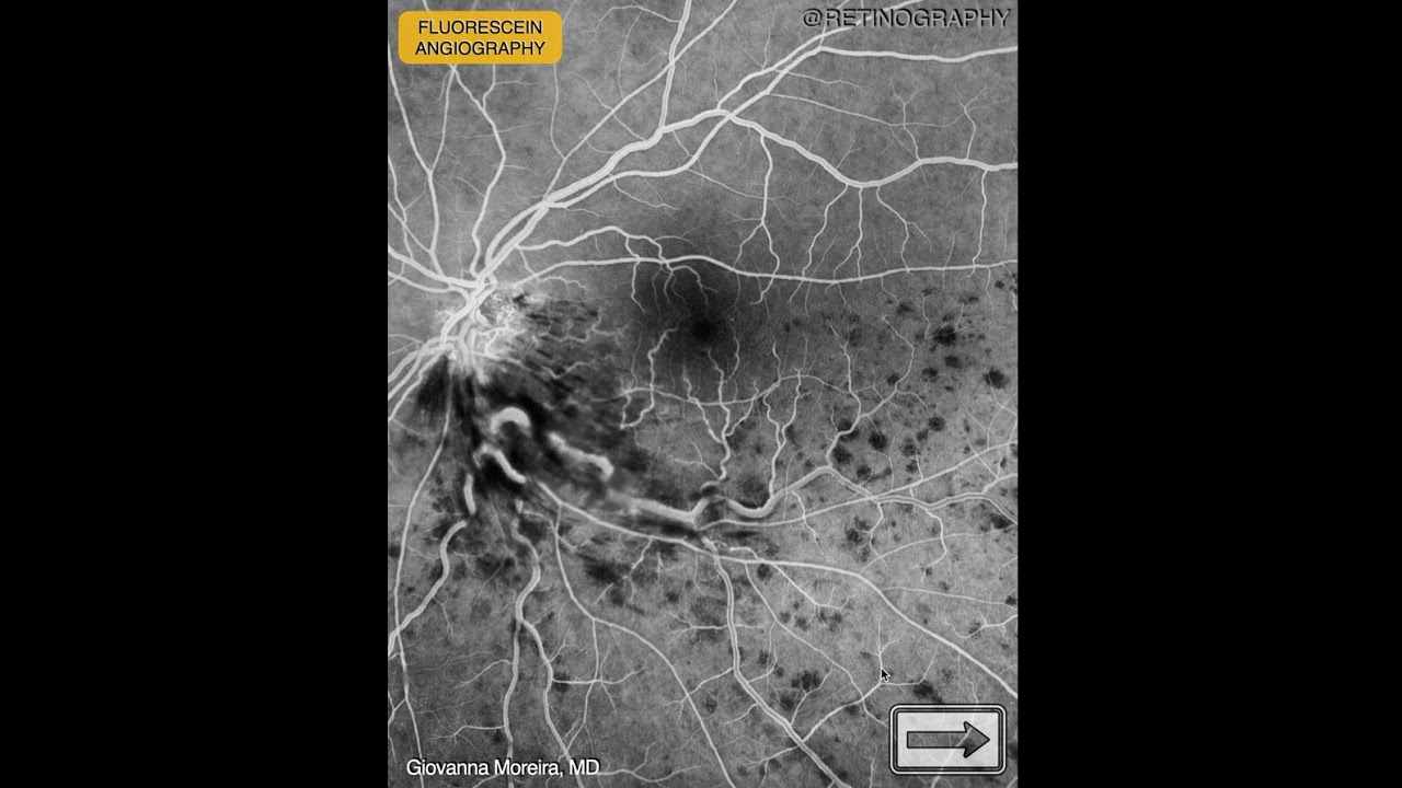 BRANCH RETINAL VEIN OCCLUSION MULTIMODAL ANALYSIS