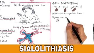 Sialolithiasis / Salivary Stones  Pathogenesis, Clinical features & Treatment