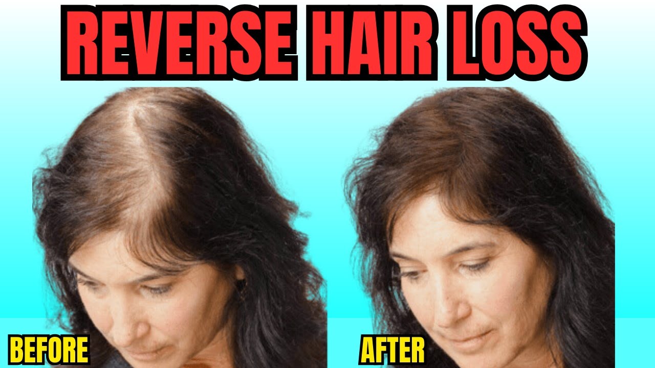 Hair Loss - Reverse Hair Loss Naturally - YouTube