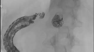 EUS-guided pseudoaneurysm embolization