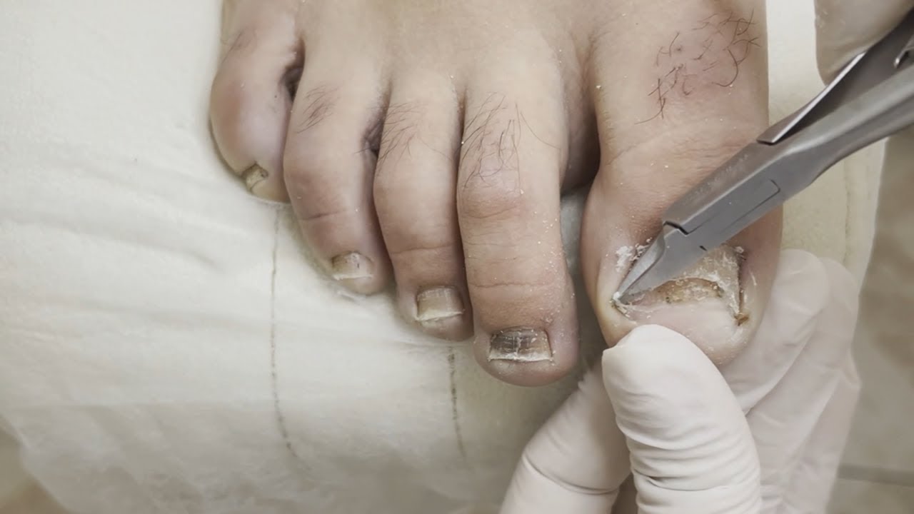 【ASMR】ingrown nail treatment Foot and Nail Care 🦶🏼【Satisfying】 YouTube