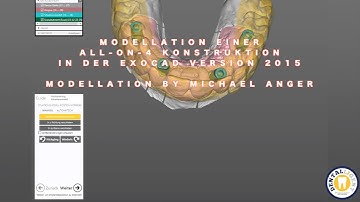 EXOCAD TUTORIAL - GRATIS - Modellation einer All-On-4 Konstruktion by Michael Anger