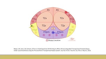 Core Videos (2020): Transperineal Prostate Biopsy Demonstration