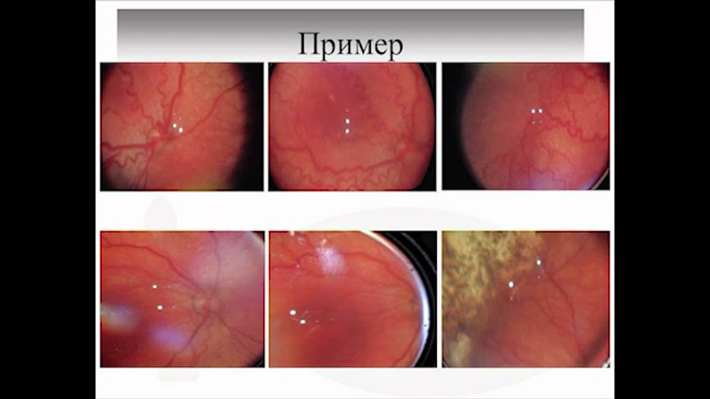 Лечение ретинопатии недоношенных - YouTube