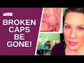 HOW TO REALLY REMOVE BROKEN CAPILLARIES