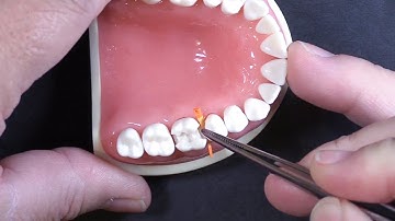 Quick Tip #4 | Where to Wedge