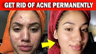 How To Permanently Cure Your Acne | 6 Powerful Home Remedies That Work! screenshot 4