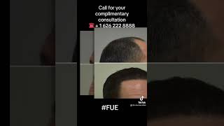 Before and After FUE Hair Transplant results with 3500 FUE Grafts