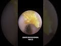 GIGANTIC SKIN PLUG REMOVAL -PART 2/3 #ear #earwax