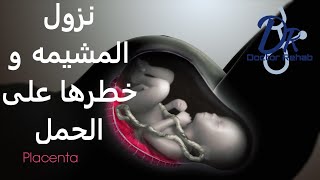 نزول المشيمه وخطره على الحامل