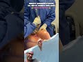 Have you ever wondered what 485CC implants look like? | Dr. Matthew Nykiel