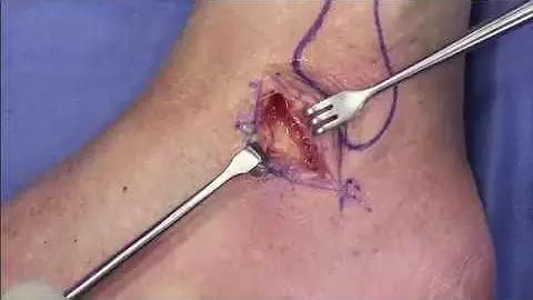 Quando rompe o ligamento do tornozelo tem que operar?