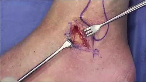 Qual anestesia para cirurgia de tornozelo?