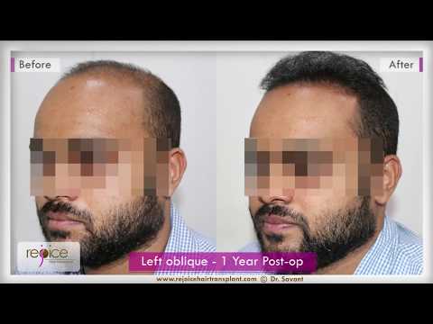 Hair Transplant