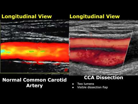Carotid Artery Color/Spectral