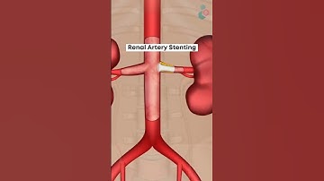 A procedure that opens up blockages in your renal arteries | 3D Medical Animation #RenalArteries