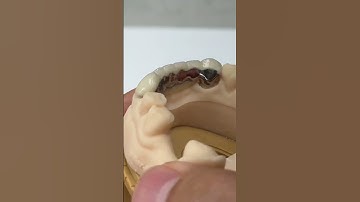 6 unit from two teeth! @EnvisiontecMain #envisiontec