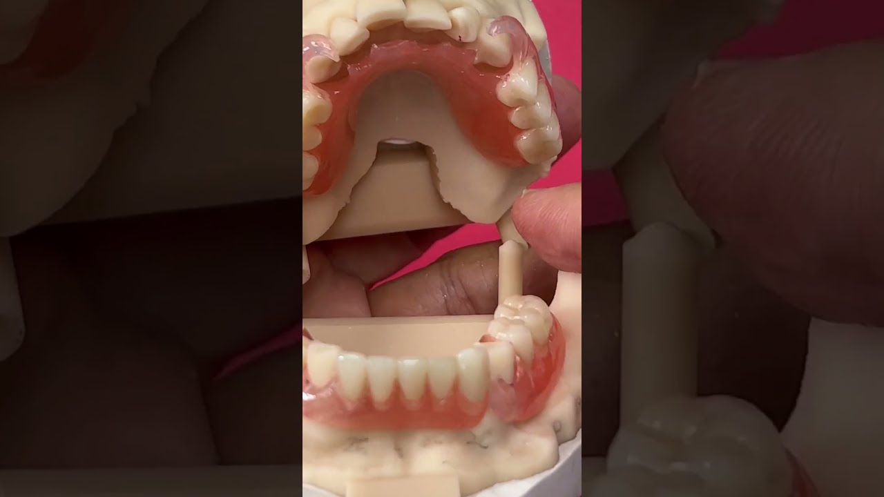 Unbreakable Flexi Partials 