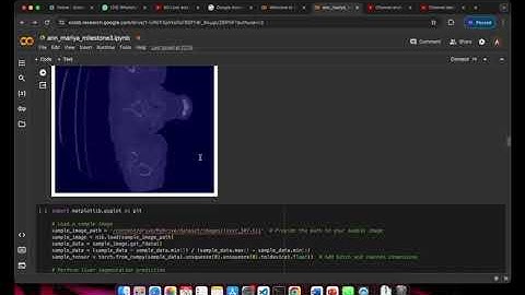 Deep Learning Liver Tumor segmentation