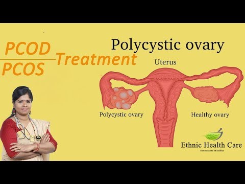 நீர்-கட்டிக்கு-சிகிச்சை-முறைகள்-|-treatment-for-pcos/pcod-|-ethnic-health-care