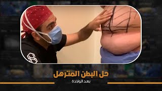 شاهد حل مشاكل الترهلات بعد الولادة مباشرة من العمليات مع د. شريف حجازي