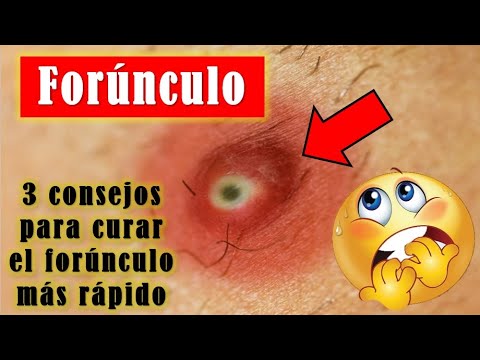 3 consejos para curar el forúnculo más rápido - YouTube