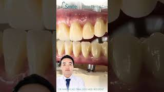 Strong yet natural full arch implant teeth #dentalimplant #dentist #over50 #smile