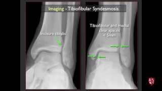 Imaging of the Tibiofibular Syndesmosis and High Ankle Sprain