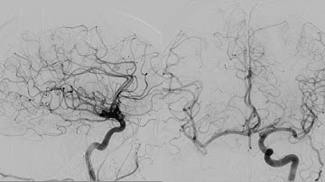 Stroke. Right Carotid Occlusion. Distal aspiration + Stentriever