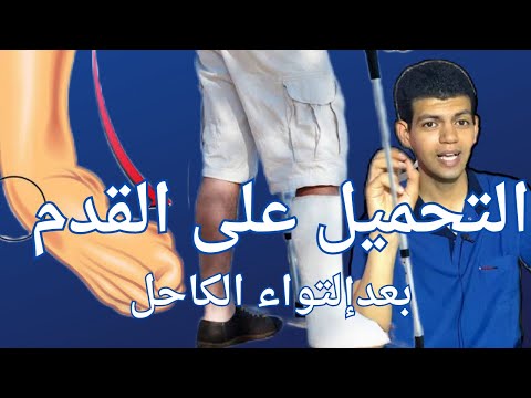 التواء القدم التحميل المباشر بعد الجبس