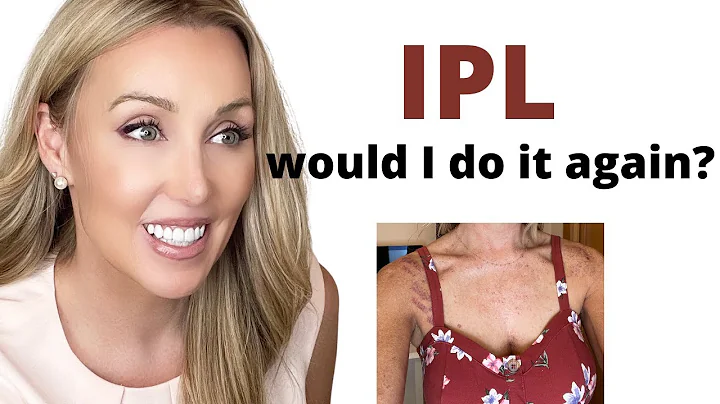 IPL WOULD I DO IT AGAIN? | Before and after pics for over 40 skin care